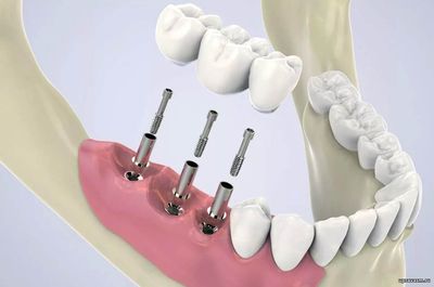 Имплантация зубов в Одинцово. Путь к совершенной, новой улыбке!